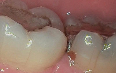 Cracked Tooth Syndrome