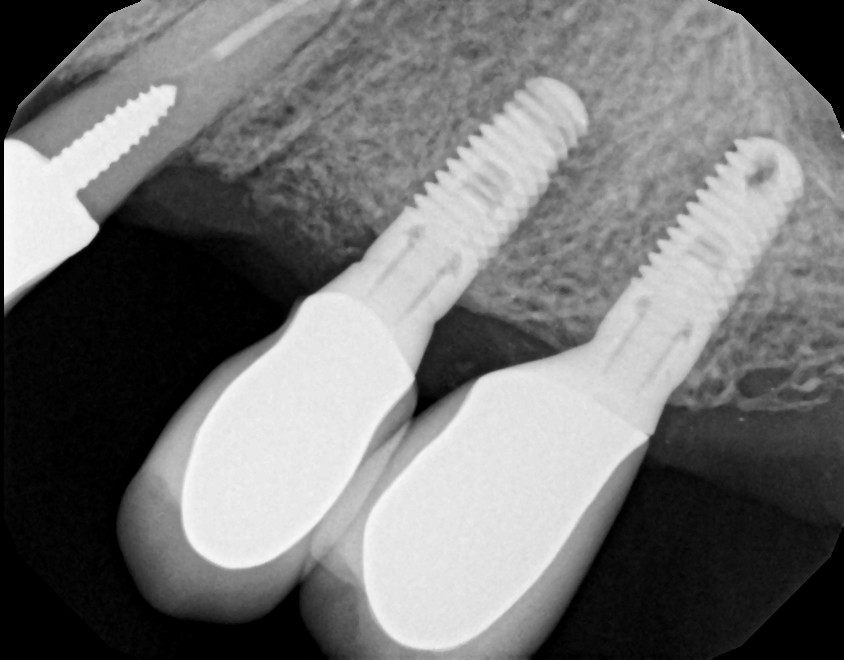 How to Maintain Dental Implants Properly